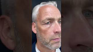 Blepharoplasty for Male Before and After at Eyes Defined #ophthalmologist #doctor #eyelidsurgery
