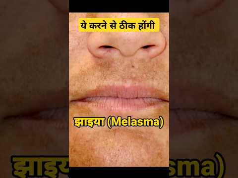 🔥 ये करने से ठीक होंगी चेहरे की झाइया (Melasma) #jhaiyan #shorts