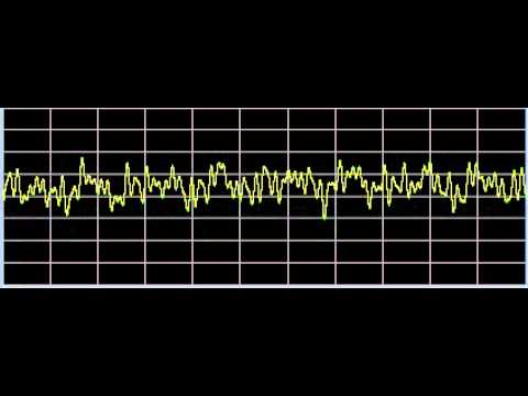 Ovarian Cysts - Rife Frequencies