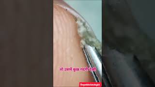 Nail under the microscop   #highlights#labtested#ytshorts#trending#yt#gudnewz#doctor#laboratory