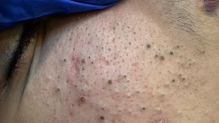 [ASMR] Blackhead Removal and Deep Pore Cleansing for Glowing Skin