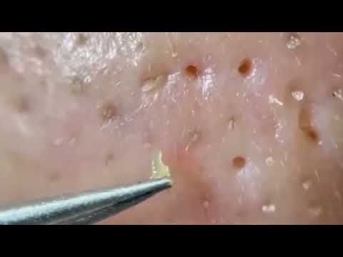小さい角栓_スポスポ角栓除去_relax_Satisfying_nose blackheads_tweezers_acne treatment_ピンセット_피지제거No.1