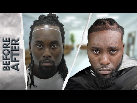 AFRO AMERICAN HAIR TRANSPLANT WITH DREADLOCKS - 1 YEAR RESULTS 3000 GRAFT