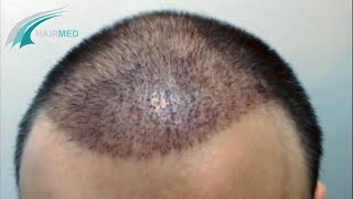 3800 greffes FUE - 16 jours post-op - Dr Ergin et Hacer Yüce - Turquie, Istanbul