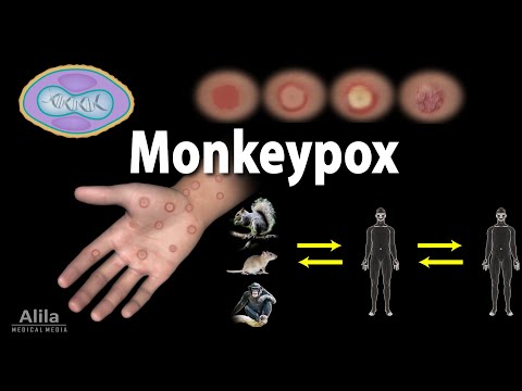 Monkeypox: Symptoms, Transmission, Prevention and Treatments, Animation