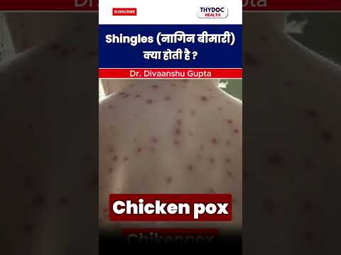 Shingles (नागिन बीमारी) क्या होती है | #shingles #shingles #doctor #shorts @ThyDocHealth