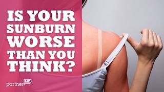 What Happens When You Get a Sunburn? The science Behind the Burn