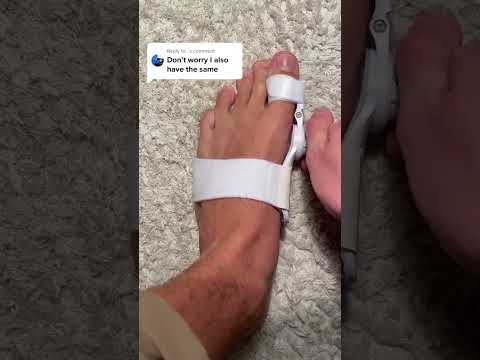 Orthopedic Toe Corrector - Say Goodbye to Foot Pain #gadgetlover #shorts #health