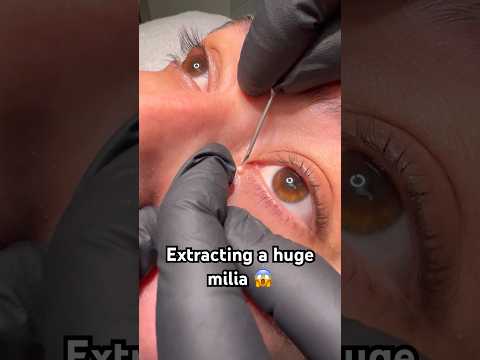 This one was SO big & in an awkward location but we got it ✨#pimplepopper #skincare