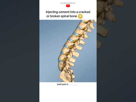 Vertebroplasty procedure #short