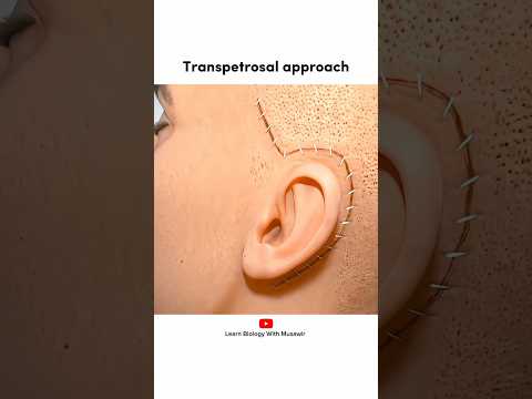 Transpetrosal surgical approach | 3D animation