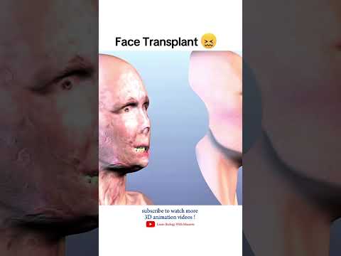 Face Transplant surgery 🎭!