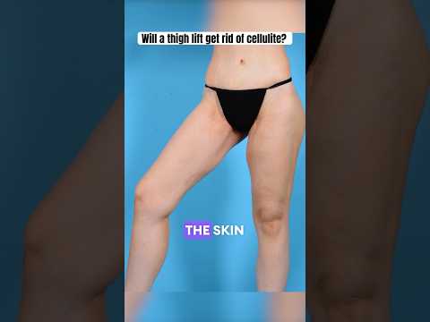 Can you reduce cellulite with a thigh lift?? #cellulite #thighlift #plasticsurgery