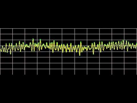 Hemangioma - Rife Frequencies