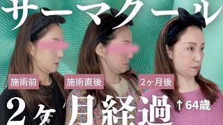 【サーマクール2ヶ月経過】🔥サーマクール後ご報告❗️効果は。。。。