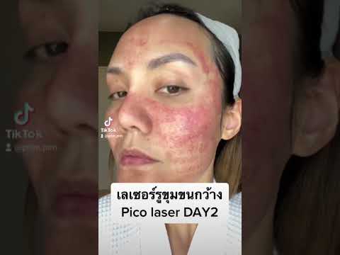 pico laser DAY2  #picolaser #makeup #แต่งหน้าเอง #แต่งหน้า #skincare