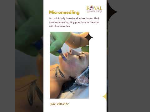 🌟 Transform Your Skin with Microneedling! 🌟