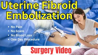 Uterine Fibroid Embolization | Surgery Video