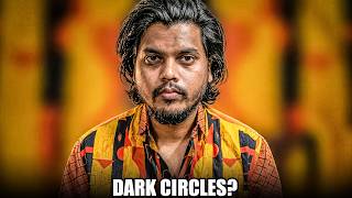 How To Remove Dark Circles Naturally | Real Reasons + Best Fixes for Men & Women