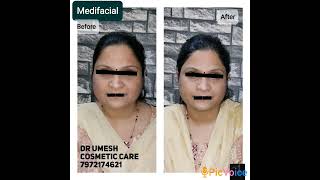 #face #skincare #cosmetic #medifacial #detanfacial #detan #skincare #skincaretips #skinglow #facial