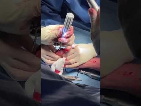 Silicone PIP Implant under Walant | Dr. Jean-Paul Brutus, Hand Surgeon in Montreal