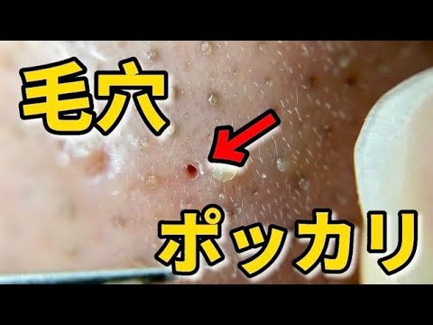 長い角栓_スポスポ角栓除去_relax_Satisfying_nose blackheads_tweezers_acne treatment_ピンセット_피지제거No.2