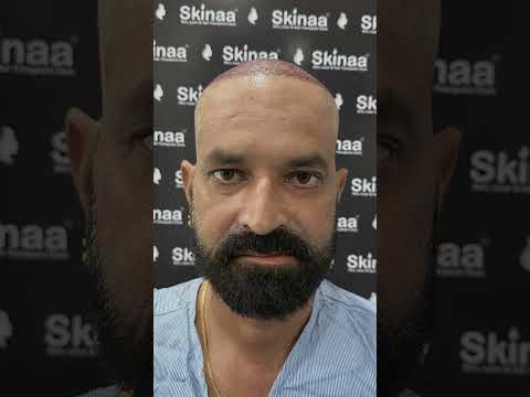 How a Hair Transplant can change your life with HT Surgery at Skinaa Clinic #viral #shortsviral