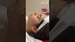 Mesoestetic Peel @ Chrysalis Pune ✨ Reveal Smooth, Radiant & Youthful Skin