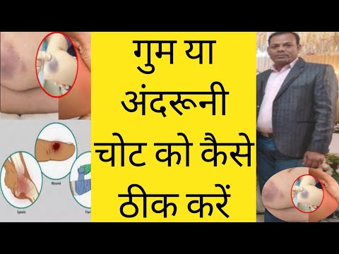 अंदरूनी चोट को कैसे ठीक करें l अंदरूनी चोट का इलाज l gum chot ka Desi ilaj