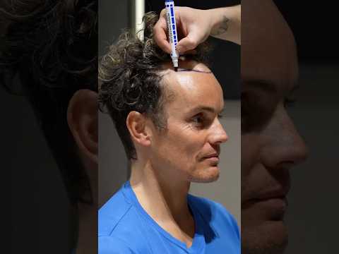 Cosmedica Clinic Hair Transplant in Turkey #shorts #hairtransplant #video