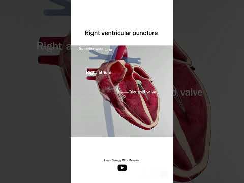 Right ventricular puncture | 3D animation