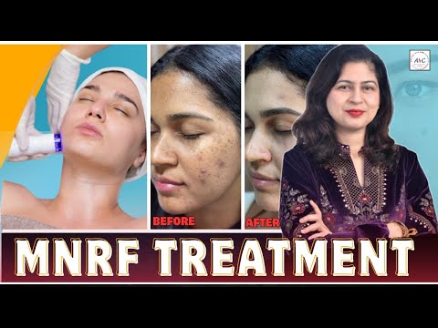 MNRF Treatment in Jammu | Clear Skin Solution for Acne, Scars & Pore Tightening | Dr Cheena Langer