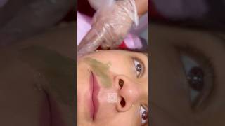 Upper Lips waxing #UpperLipswaxing #HairRemoval #Shorts