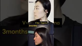 Korean V-Line Surgery + Zygoma Reduction Surgery Results | (Before & After)