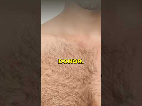 Body Donor Hair Transplant ?#drranairfan #HairFall #bodyhair  #hairtransplant #fyp #shorts