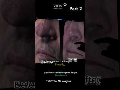 Rhinophyma 🤔 understanding the condition with Dr.De la Fuente Pt.2 ✨ #dermatologist #isotretinoina