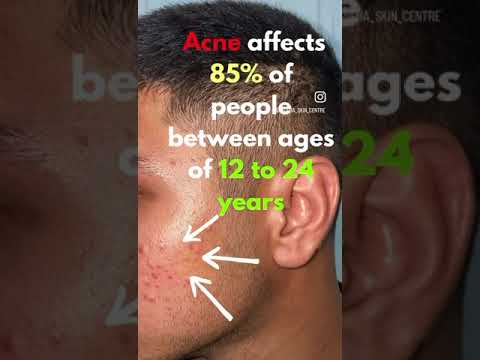 Acne Facts | PIMPLES | Acne treatment | Best acne treatment
