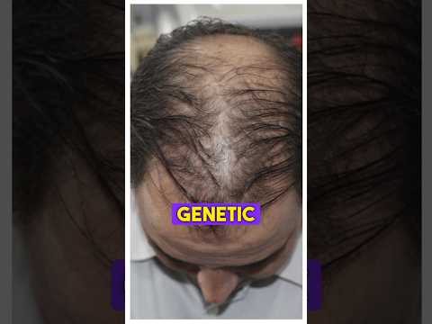 Treatment for Hairfall/loss ?#drranairfan #hairfall #hairtransplant #hairloss #fyp #shorts