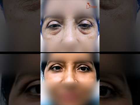 Say Goodbye to Puffiness & Sagging Under-Eye Skin with Lower Blepharoplasty! #ytviral