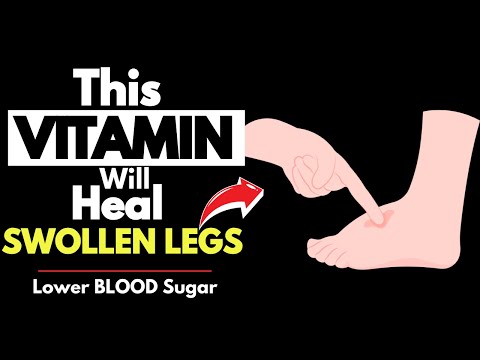 Another Overlooked Vitamin That Supports Leg Health in Diabetics – Part 2