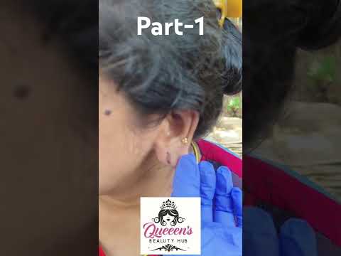 #earloberepair#goviral#earlobetreatment#Queensbeautyhub#bhubaneswar#booknow-8143005510