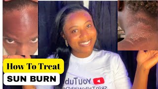 This is the honest and best way to treat and heal your sunburn effectively.