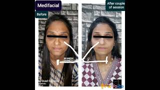 #medfacial #skinwhitening #skinlightening #face #cosmetic #skincare #skincare #detanfacial #glowup