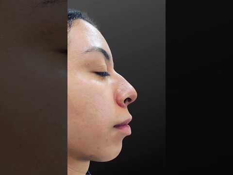 ✨ Discover the magic of Liquid Rhinoplasty with Dr. Castañeda! ✨