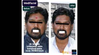 #face #galvanicafacial #skincare #medifacial #skincare #skincaretips #glowingskin #glow #detanfacial