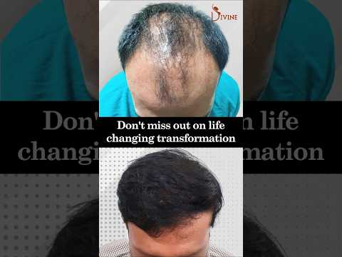 Hair Transformation: 10,000 Follicles Restored for a Youthful Look | Hair Transplant