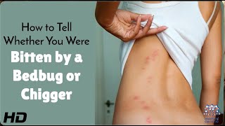 Bug Bite Mystery Solved: Bedbugs or Not?