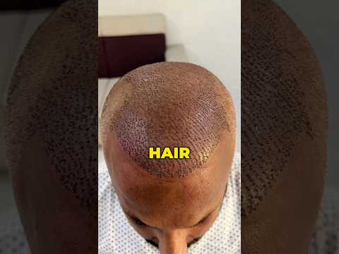 If Transplanted Hair Didn't Grow ?#drranairfan #HairFall #hairloss #hairtransplant #fyp #shorts