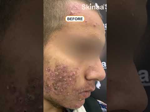 Black Peel Treatment for Acne at Skinaa Clinic #shorts #viral