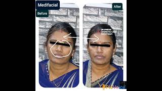 #face #cosmetic #skincare #medifacial #skinlightening #detanfacial #detanning #glowingskin #skin